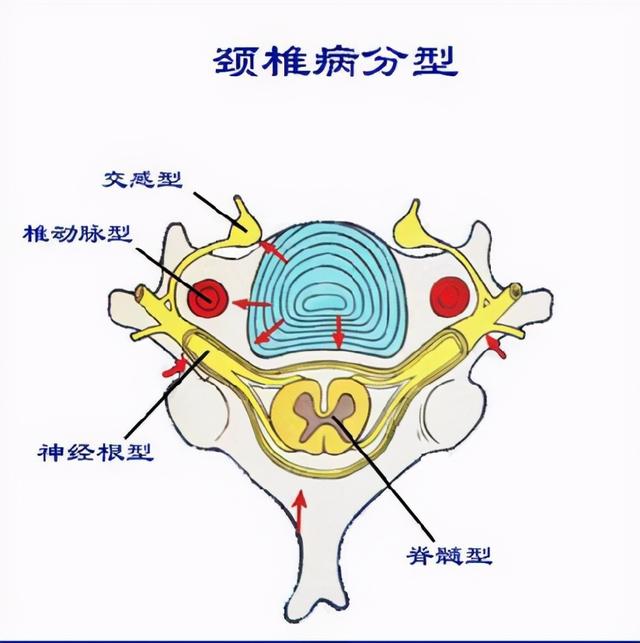 拔火罐可以缓解颈椎病吗（拔火罐可以治疗颈椎病吗）(3)