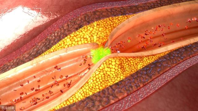 血管堵塞的10个征兆和治疗方法（身体出现5个现象）(1)