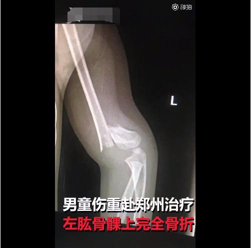 小孩从滑梯摔下来（男童被踹下滑梯胳膊折成三截）(4)