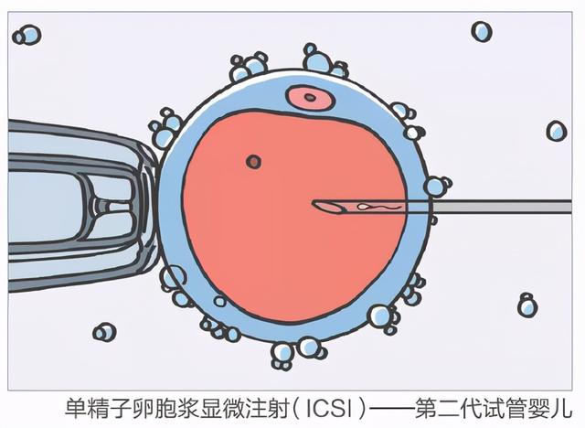 辅助生殖技术有哪几类（常见的辅助生殖技术有哪些）(5)