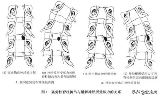 腰椎间盘突出症的正确治疗（腰椎间盘突出症诊断与治疗）(23)