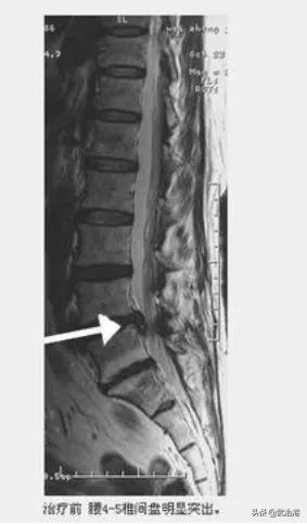 腰椎间盘突出症的正确治疗（腰椎间盘突出症诊断与治疗）(18)