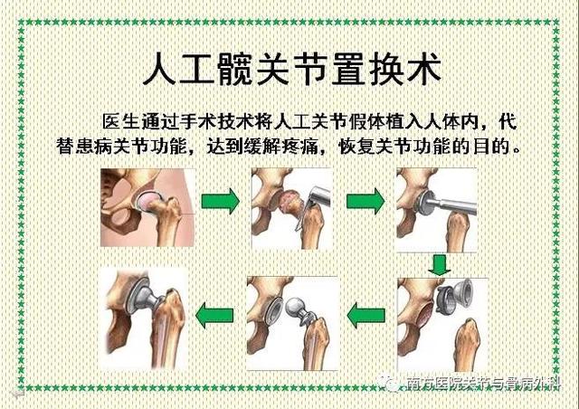 全髋关节置换术知识要点（一起走进人工髋关节置换术）(5)