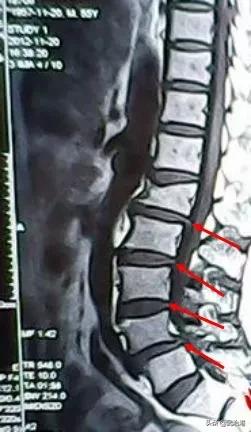 腰椎间盘突出症的正确治疗（腰椎间盘突出症诊断与治疗）(19)