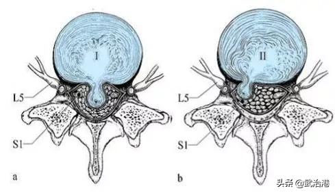 腰椎间盘突出症的正确治疗（腰椎间盘突出症诊断与治疗）(15)