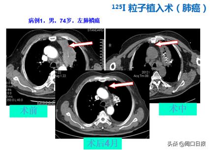 粒子植入是治疗恶性肿瘤吗（恶性肿瘤放射性粒子植入微创治疗）(7)