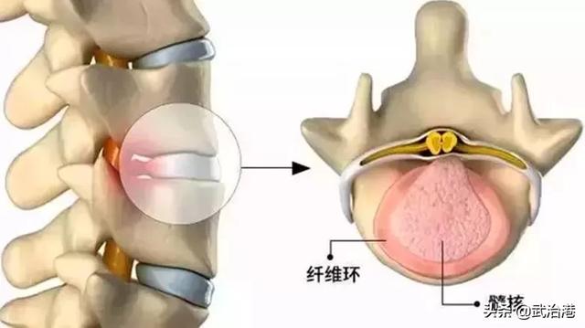 腰椎间盘突出症的正确治疗（腰椎间盘突出症诊断与治疗）(11)