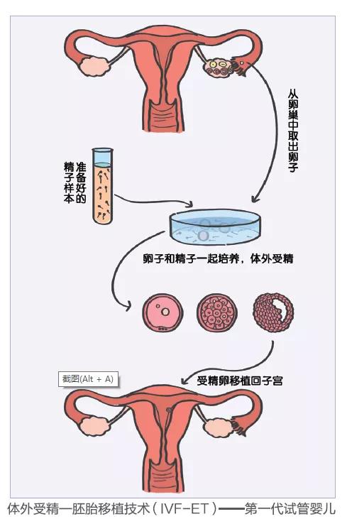 辅助生殖技术有哪几类（常见的辅助生殖技术有哪些）(4)