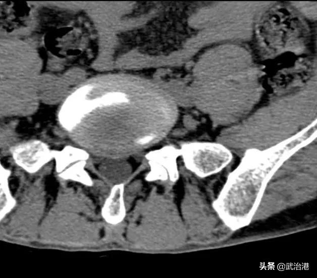 腰椎间盘突出症的正确治疗（腰椎间盘突出症诊断与治疗）(36)