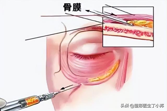 眼袋泪沟上眼皮肿打什么水光针（北京面部泪沟注射物取出）(3)