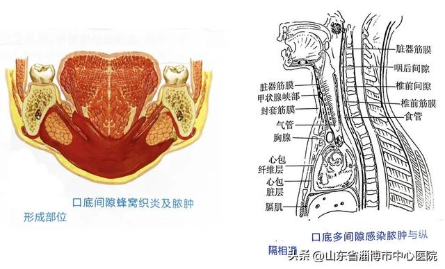 牙龈炎症引起的牙疼怎么治（颌面部间隙感染真的能）(6)